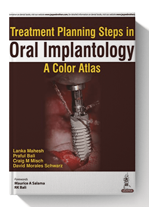 Treatment Planning Steps in Oral Implantology: A Color Atlas