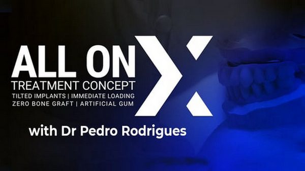 All-On-X-treatment-concept